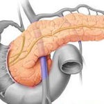 Transzplantációs a hasnyálmirigy cukorbetegség tranzakciós ár Magyarországon (prosztata) Transzplantációs a hasnyálmirigy cukorbetegség műtét Magyarországon ár