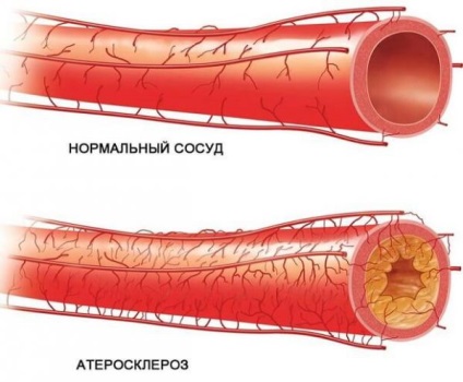 Étkezés után koszorúér bypass beültetés (CABG) étrend szabályok és ajánlások