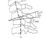 Subluxation a csigolya - okai, tünetei, diagnózisa és kezelése