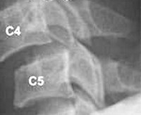 Subluxatio vertebrális - okai, tünetei, diagnózis és kezelés (subluxation) Subluxation a csigolya - okai, tünetei, diagnózisa és kezelése