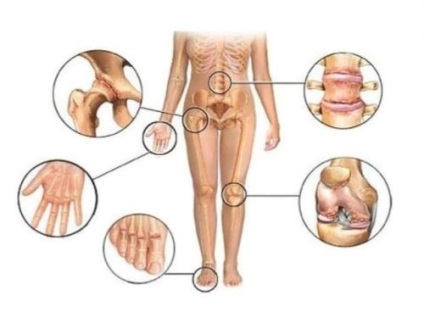 Poszttraumás arthritis okok, tünetek, kezelés