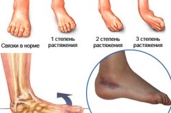 Foot rándulás tünetei és kezelése