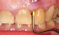 A tünetek és a periodontitis kezelése az alsó vagy a felső állkapocs