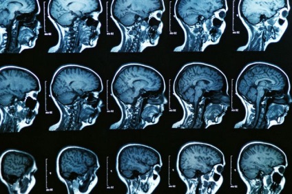 Meddig agyi MRI