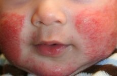 Streptoderma gyermek fotó, mint egy kezdő, hogyan kell kezelni