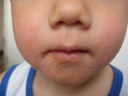 Streptoderma gyermek fotó, mint egy kezdő, hogyan kell kezelni