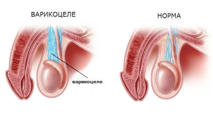 Varicocele a férfiak és kamasz, műtét, tünetek, okok, hatások