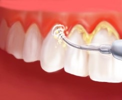 Miért professzionális fogtisztítás a fogorvos, a német fogászat (fogorvos) Miért professzionális fogtisztítás a fogorvos, a német Dental