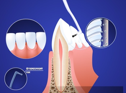 Miért professzionális fogtisztítás a fogorvos, a német Dental