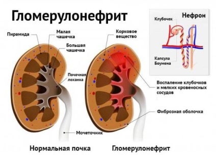 Mennyire veszélyes torok komplikációk és következményei a betegség