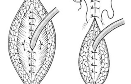 Epitsistoma hólyag fotók, fogaskerék, gondoskodás