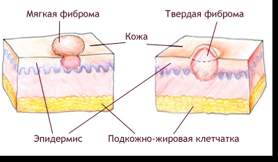 bőr kezelésére fibróma lágy és kemény fibrómák (fibrómák) arckezelés fibróma lágy és kemény mióma