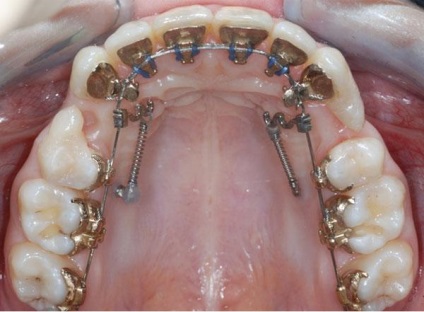 Hogyan tegyük fogszabályozó fogak