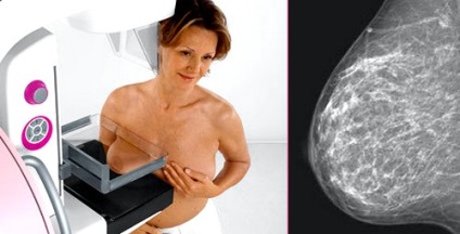 Mammográfiás mell