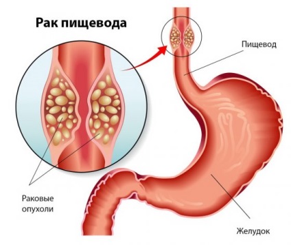 A tumor a nyelőcső tünetek, jelek, a kezelés