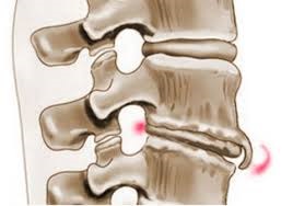Osteophytes a háti gerinc