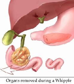Pancreatoduodenectomia - nagy eredményeket klinikán Assuta, Assuta (Whipple művelet) Pancreatoduodenectomia - jó eredményeket a klinikán Assuta, Assuta