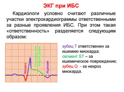 Tünetei a szívkoszorúér-betegség, koszorúér-betegség EKG