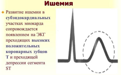 Tünetei a szívkoszorúér-betegség, koszorúér-betegség EKG
