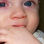 Jelek és tünetek a diszplázia csecsemők