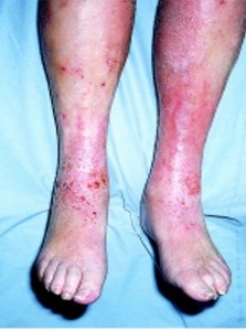 A bőrallergia tünetei és kialakulásának okai Fotó ekcéma a visszeres lábakon