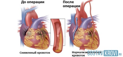 egészségügyi szív bypass