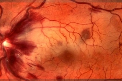 Thrombosis szem (központi retinális véna) tünetek és kezelés