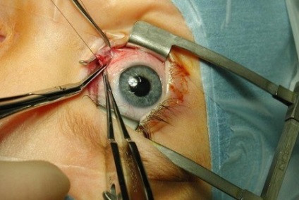 Thrombosis szem (központi retinális véna) tünetek és kezelés