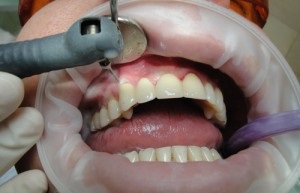Vector fogászati ​​mi ez - a periodontális betegség kezelésében és fogmosás