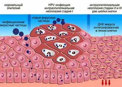 HPV 16, 18 típusú fő elvei kezelés, gyógyszeres kezelés és az invazív, módszerek népi