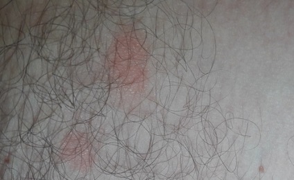 Viszketés és hámlás a lágyéki Photo, esetleges betegség, kezelés, Nemikórtani világ (peeling) Viszketés és hámlás a lágyéki Photo, esetleges betegség, kezelés, Nemikórtani világ