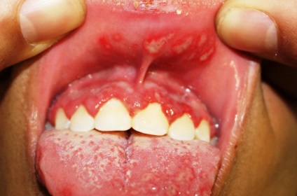 Viszketés a száj fő oka annak előfordulása
