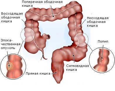 Adenocarcinoma a szigmabélen prognózist, kezelési