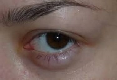 Allergiás szemhéj oedema megnyilvánulása, diagnózis és kezelés (kezelés) Allergiás a szemhéjak megnyilvánulás, diagnosztizálására és kezelésére