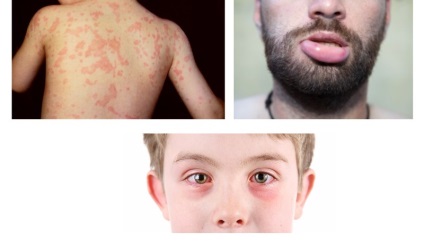 Allergia cikóriát is ott lehet, mint látható, okoz, a tünetek, diagnózis, kezelés