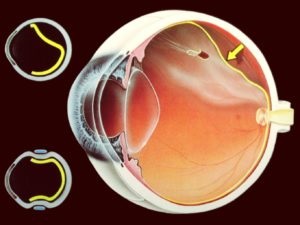 retina atrófia kezelése a tünetek