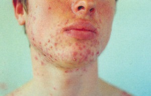 Autohaemotherapy akne saját vére gyógyítani akne (pattanások autohemotherapy oka az akne) Autohaemotherapy akne saját vére gyógyítani akne