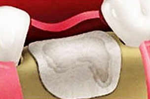 A váiaszfalmembránt fogászatban a telepítés során a membrán csontpótló a «dentalpro» klinikán!