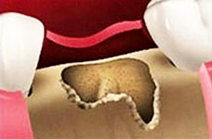 A váiaszfalmembránt fogászatban a telepítés során a membrán csontpótló a «dentalpro» klinikán!