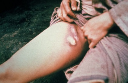 Fekete Halál - érdekes tény a pestis (pestis) Fekete Halál - érdekes tény a pestis