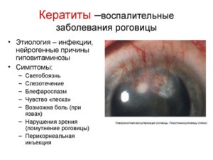 Mi astigmia felnőtt és egy gyermek (fotó) - Mi ez veszélyes, és hogyan, hogy ha (felnőtt) Mi astigmia felnőtt és egy gyermek (fotó) - Mi ez veszélyes, és hogyan, hogy lássa,