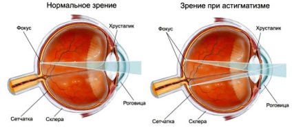 Mi astigmia felnőtt és egy gyermek (fotó) - Mi ez veszélyes, és hogyan, hogy ha ez (a szem) Mi astigmia felnőtt és egy gyermek (fotó) - Mi ez veszélyes, és hogyan, hogy lássa,