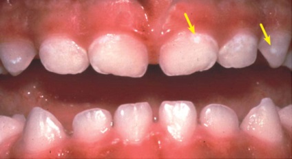 Demineralizálására zománc - etiológia és kezelés demineralizálására fogak - a fogászati ​​portál