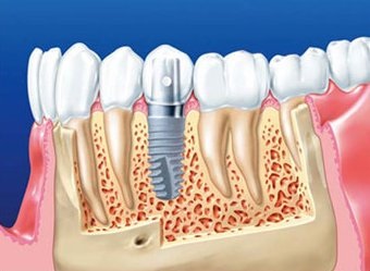 Fogászati implantátumok (fogászati implantátumok) fogászati implantológia