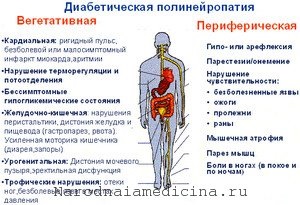 Diabetikus neuropátia (diabetikus) diabeteses polyneuropathia