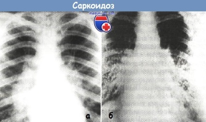 Differenciálása sarcoidosis tuberkulózisban