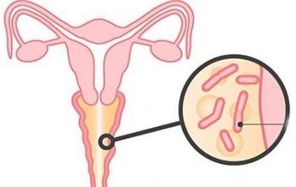 vaginális dysbiosis tünetek és a kezelés (tünetek) vaginális dysbiosis tünetek és a kezelés