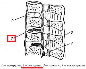 Háti extrudálás, a kezelés és diagnózis (háti) Háti extrudálás, a kezelés és diagnózis