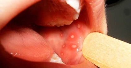 Hatékony kezelés a stomatitis gyermekek és felnőttek népi jogorvoslat - a fogak (stomatitis) Hatékony kezelés a stomatitis gyermekek és felnőttek népi jogorvoslat - a fogak