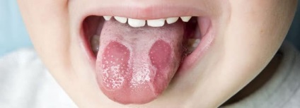Hatékony kezelés a stomatitis gyermekek és felnőttek népi jogorvoslat - a fogak (népi) Hatékony kezelés a stomatitis gyermekek és felnőttek népi jogorvoslat - a fogak